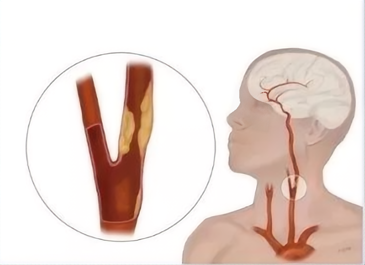 超千万中国人体检结果：两成有颈动脉斑块